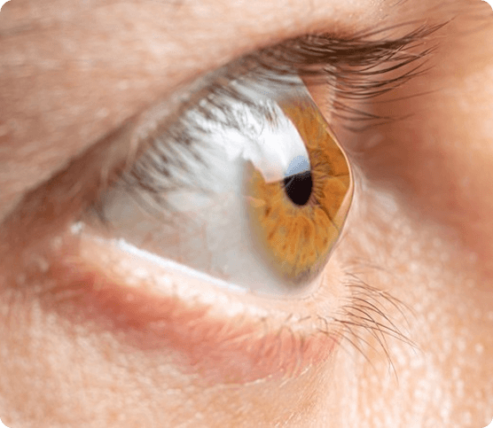 Keratoconus Risk and Factors